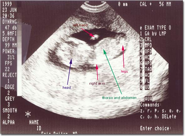 fetus at 12 weeks. fetus at 12 weeks. uterine cavity at 12 weeks; uterine cavity at 12 weeks
